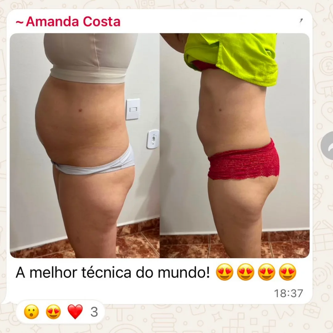 Depoimento de aluna do Diástase Dream