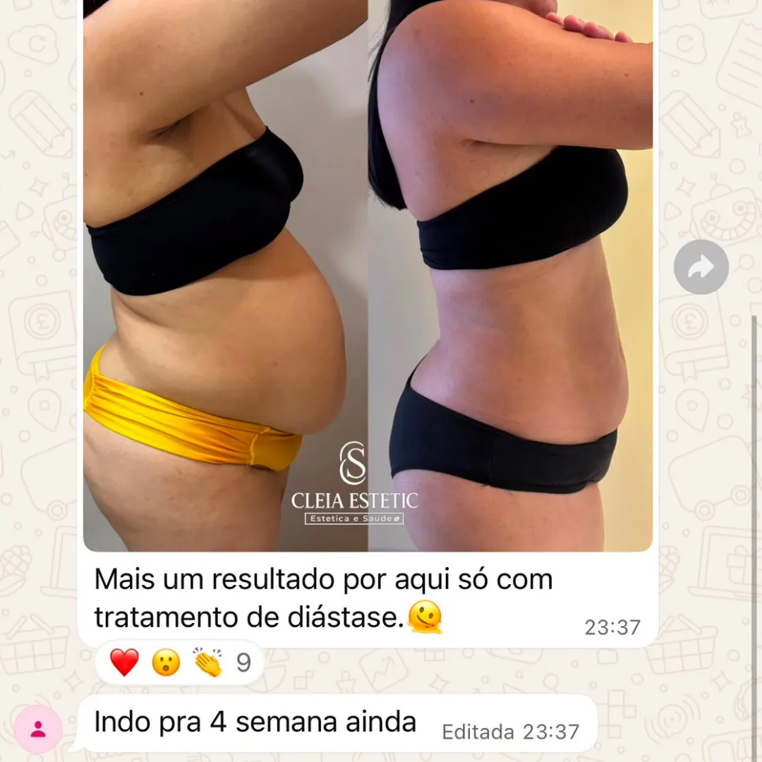Depoimento de aluna do Diástase Dream