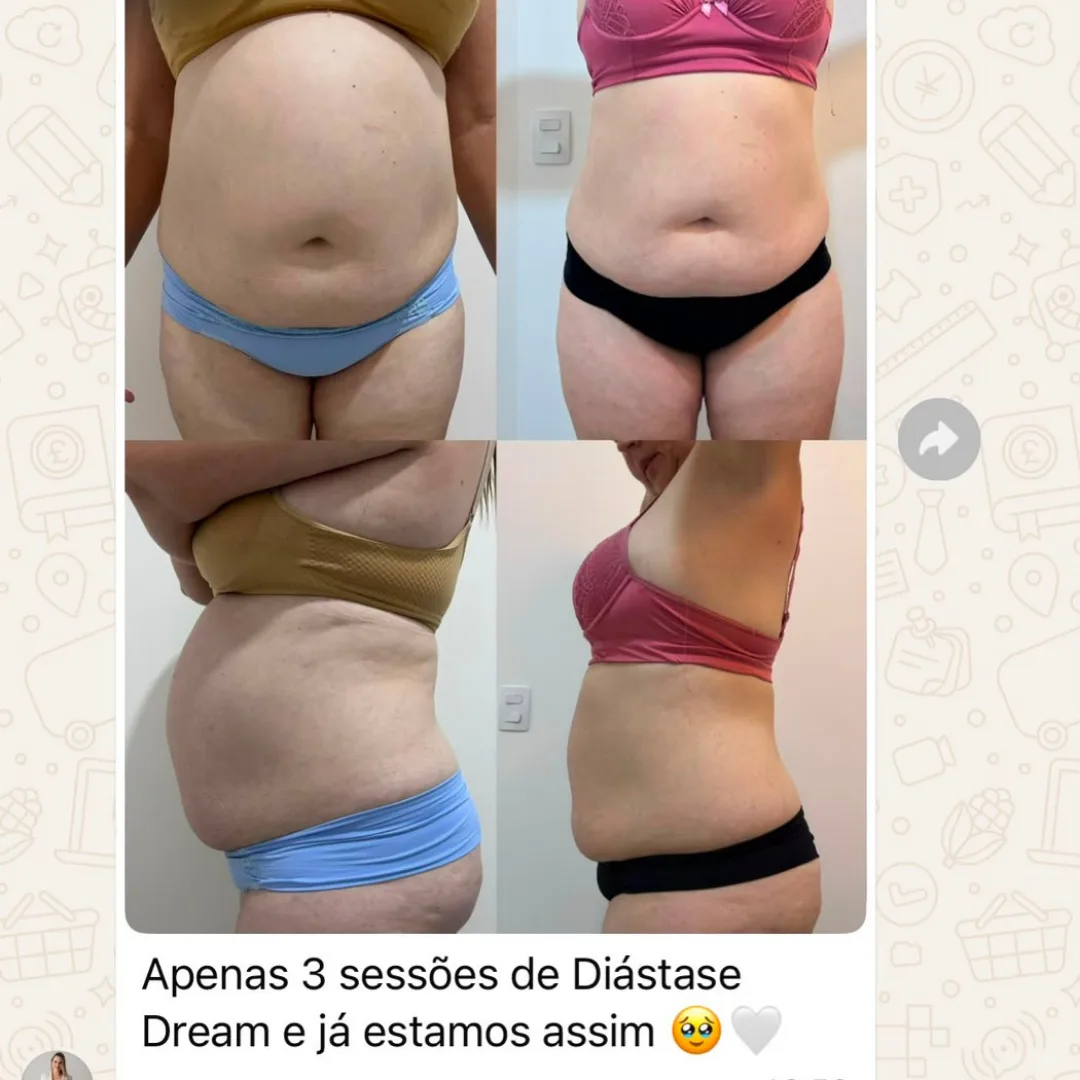 Depoimento de aluna do Diástase Dream