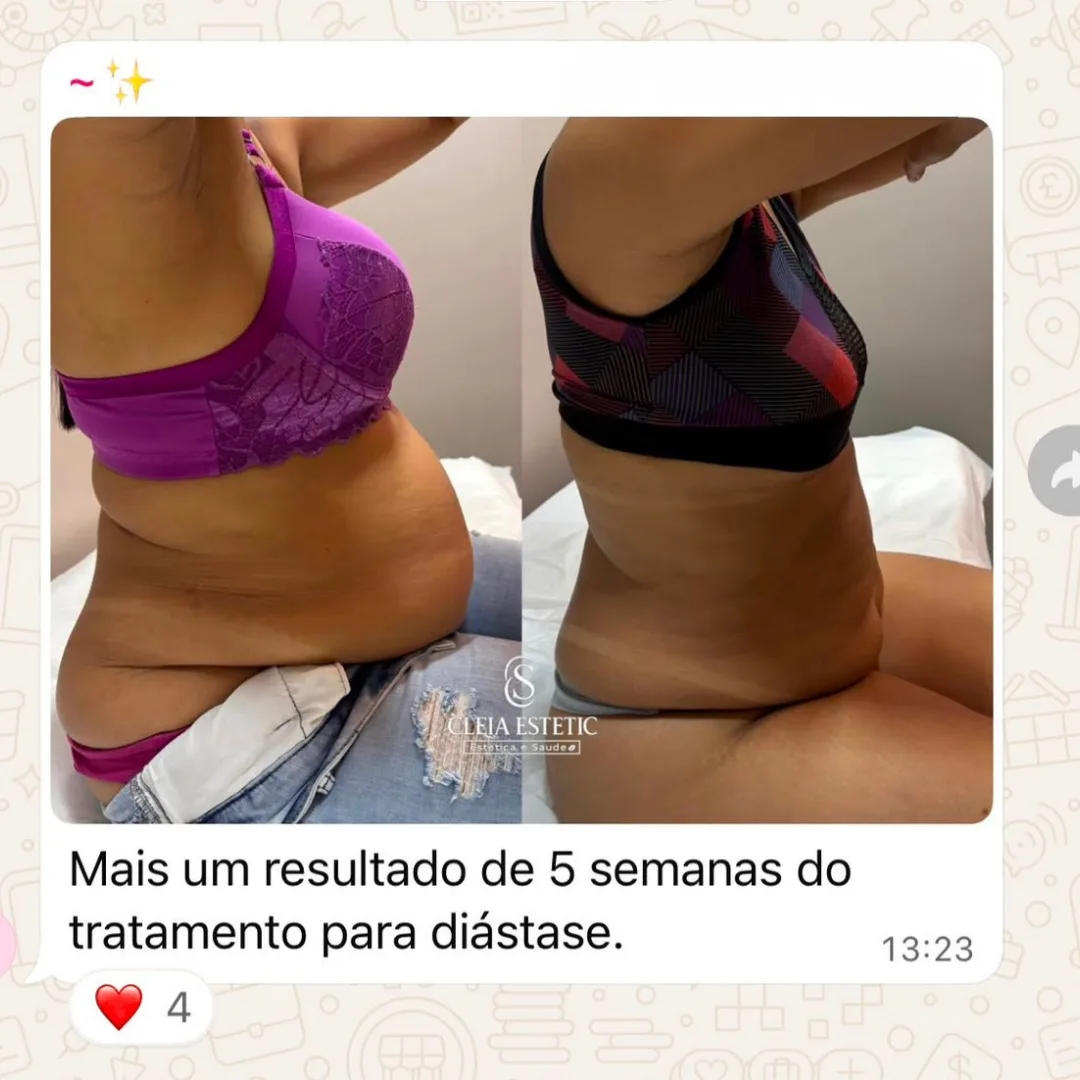 Depoimento de aluna do Diástase Dream
